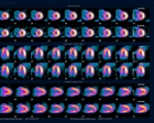 Stress/rest Myoview, Pulmonary Htn 