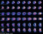 Left Anterior Descending Ischemia