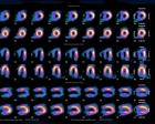 LAD and RCA ischemia with TID 