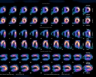 LAD and RCA ischemia with TID