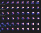 TID in Multivessel Ischemia