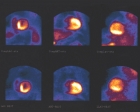 Composite Stress and Rest Myocardioal Perfusion, (Gated) Planar Mibi of a Morbidly Obese Male