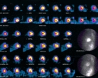 Normal Tl201 perfusion in female patient