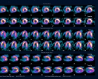 Right Coronary Ischemia