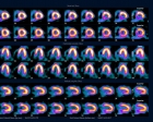 Right Coronary Ischemia