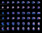 Right Coronary Ischemia