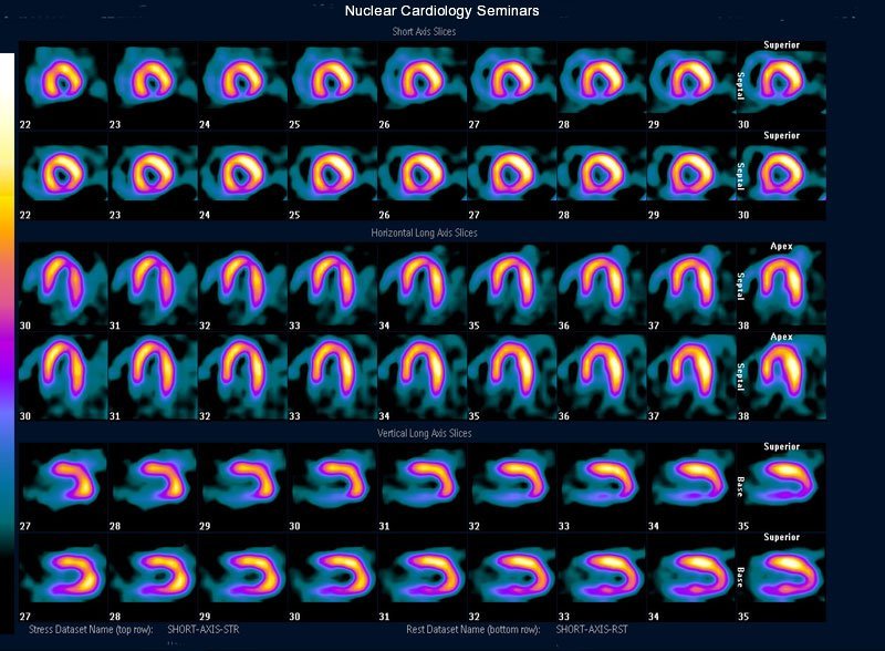 Right Coronary Artery