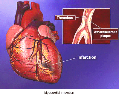 infarction
