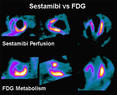 mibi+fdg2