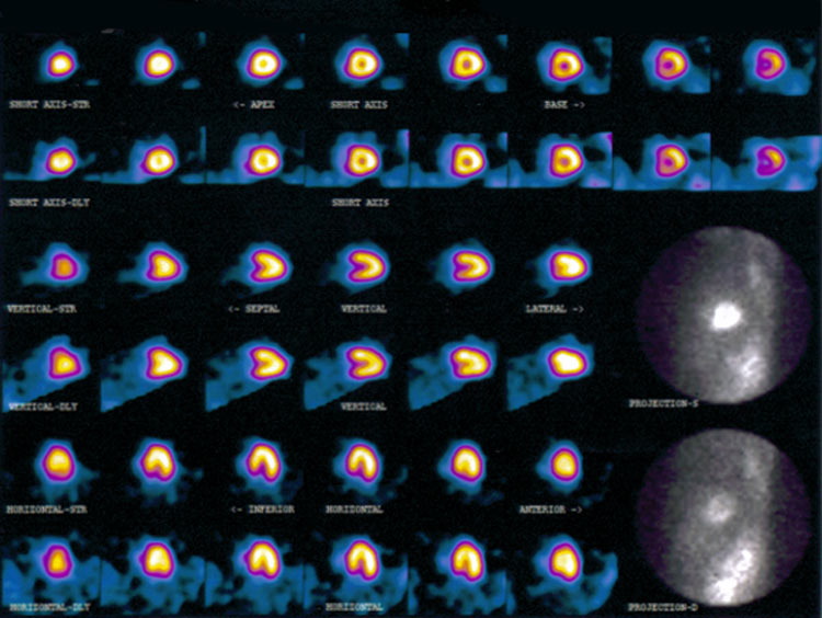 Normal Tl201 exam in female patient