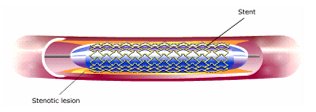 stent